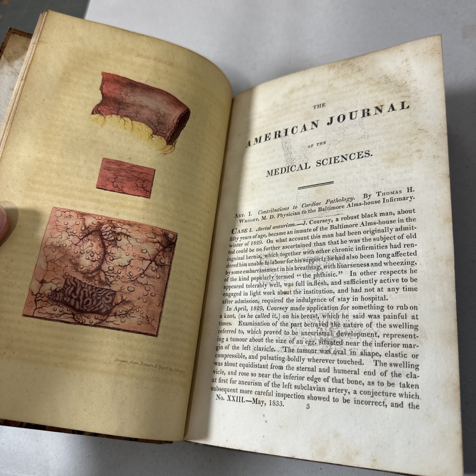 American Journal Medical Sciences 1833 First Edition Book Plates Volume 12